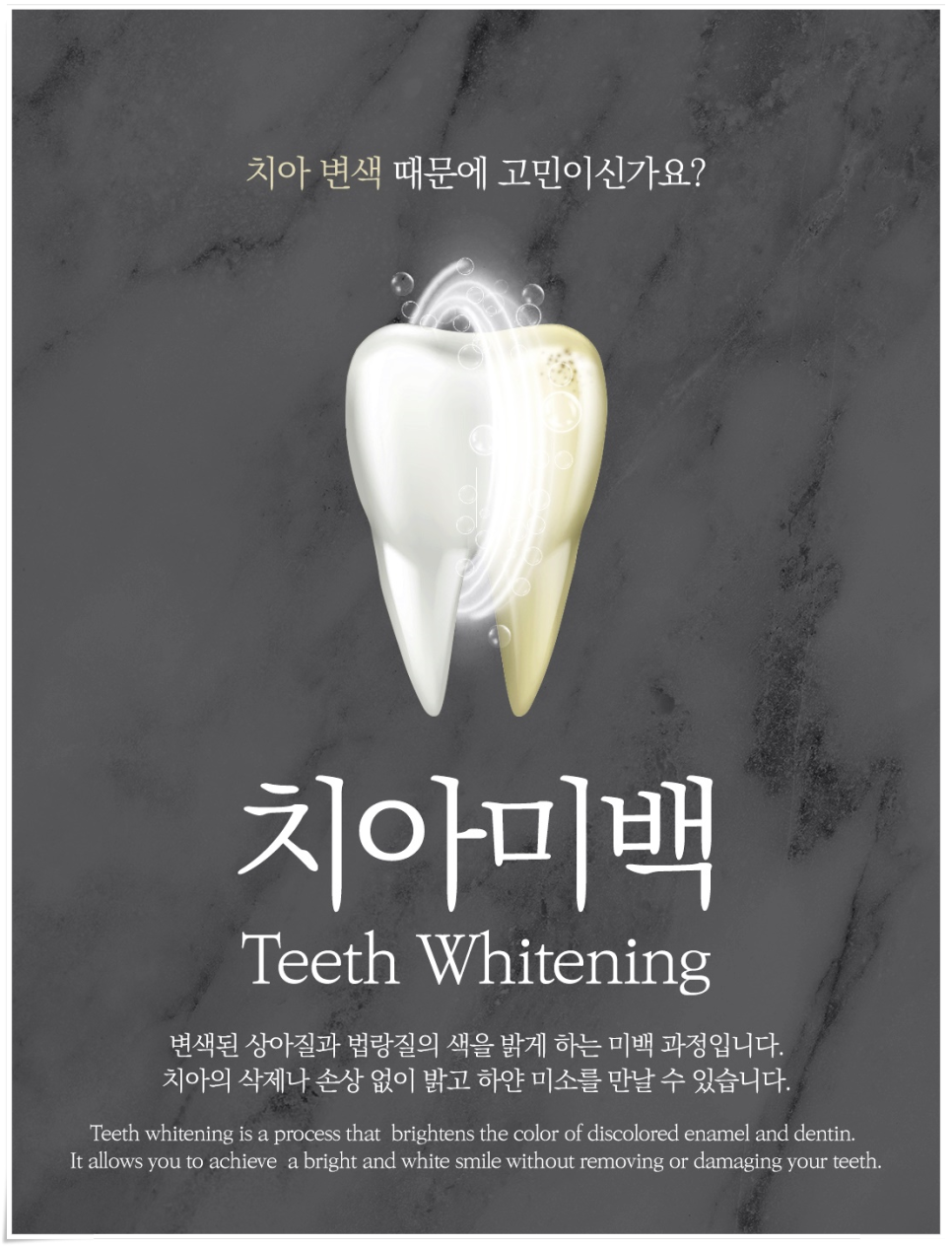 외국인치과에서 알려주는 치아미백 진실 관련 이미지 3