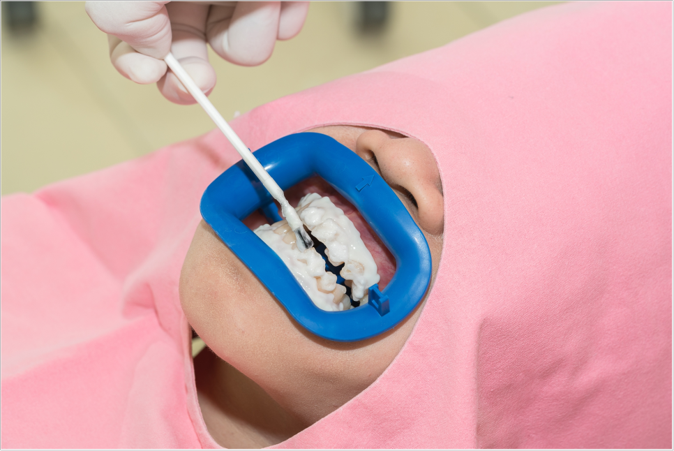 을지로치과 치아미백 후 관리 잘하고 계신가요? 관련 이미지 8