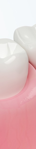 종로치과추천 나이별 &middot; 상황별 임플란트 치료 방법 관련 이미지 28