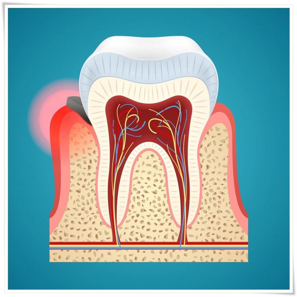 노화가 치아 건강에 영향을 미치나요? 관련 이미지 5