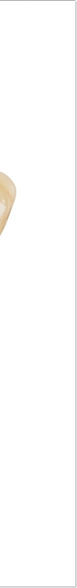 광화문치과 라미네이트 치료 전 고민해야 할 것 관련 이미지 12