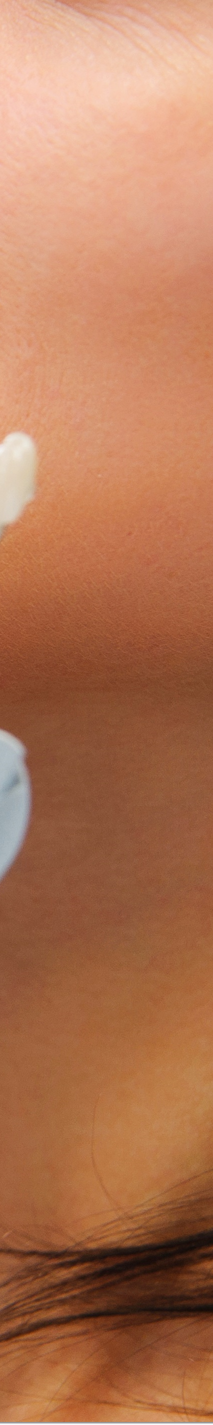 광화문역치과 라미네이트 치료가 궁금해요 관련 이미지 37