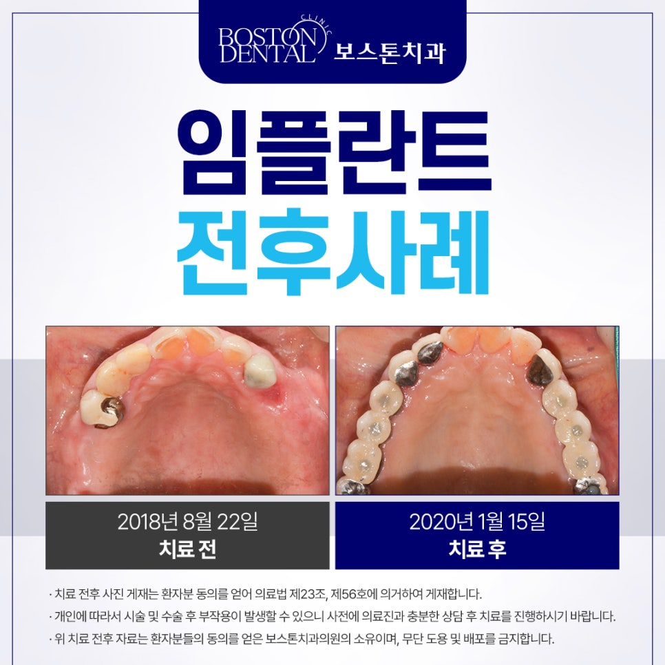 종로3가치과 틀니 사용 중인데 불편해서 임플란트 하고 싶어요 관련 이미지 2