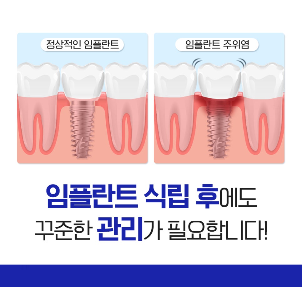 종로치과추천 나이별 &middot; 상황별 임플란트 치료 방법 관련 이미지 8