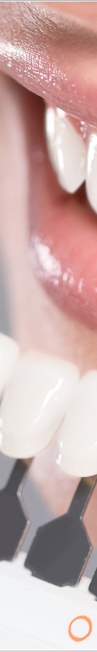 명동라미네이트, 단시간에 환한 미소를 가지고 싶다면? 관련 이미지 20