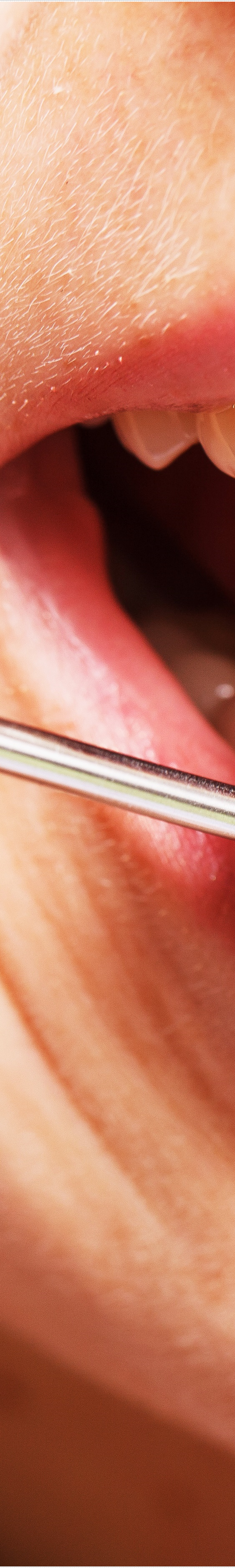 을지로입구역치과에서 알려드리는 치아미백과 라미네이트의 모든 것 관련 이미지 12