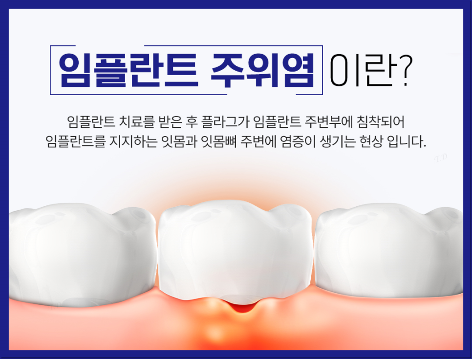 종로치과 임플란트 재식립이 필요하다면? 관련 이미지 3