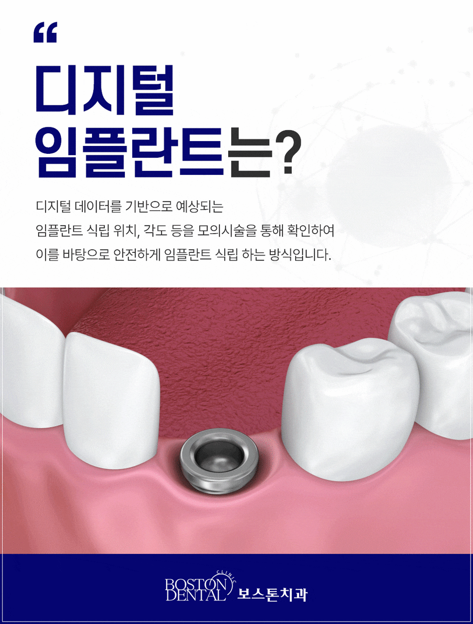 종로임플란트 만족도를 높이기 위해서는 관련 이미지 2