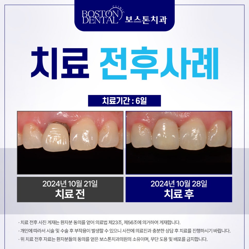 을지로치과 오래된 보철로 앞니가 보기 싫어요ㅠ 관련 이미지 4