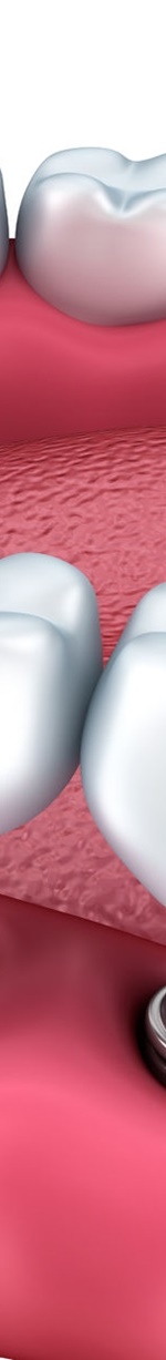 종각역치과 충치를 방치하면 신경치료를 해야 한다. 관련 이미지 14