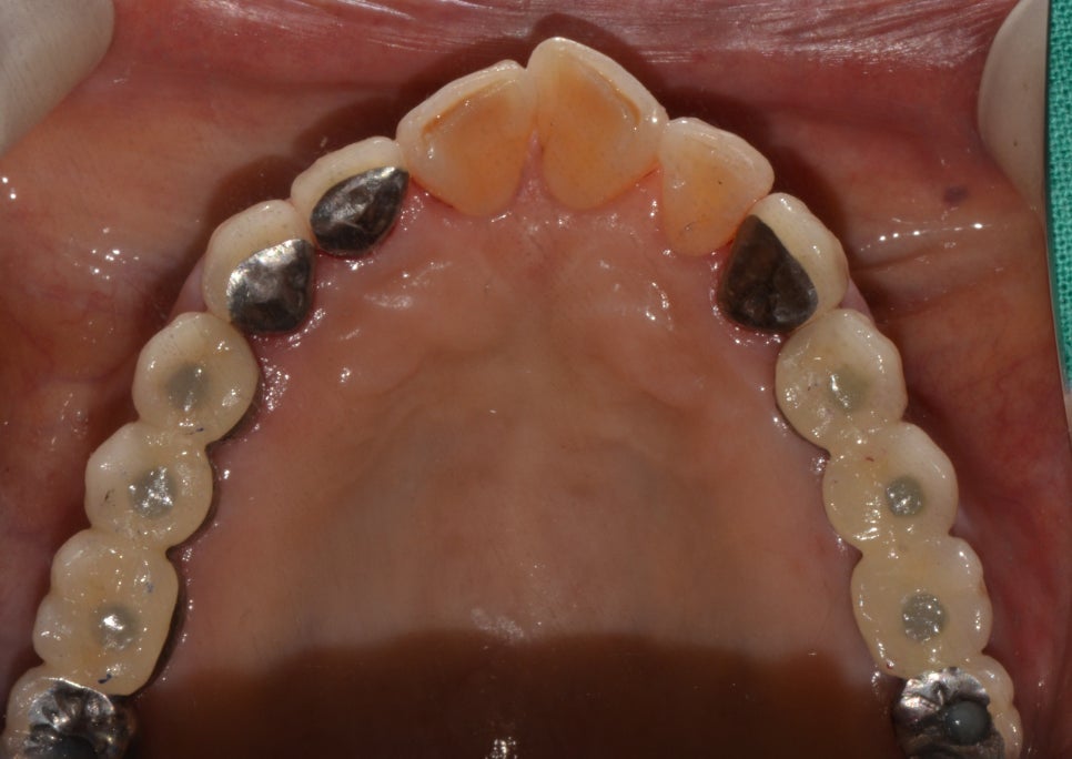종로3가치과 틀니 사용 중인데 불편해서 임플란트 하고 싶어요 관련 이미지 5