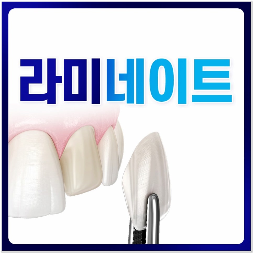 치아 변색 고민 끝, 을지로치과에서 듣는 라미네이트 사례 관련 이미지 1
