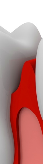 광화문치과 라미네이트 깨짐&middot;들뜸 원인과 예방 방법 완벽 정리 관련 이미지 8