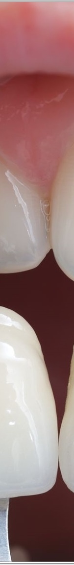 명동치과 치아 라미네이트의 모든 것: 앞니부터 어금니까지 관련 이미지 10