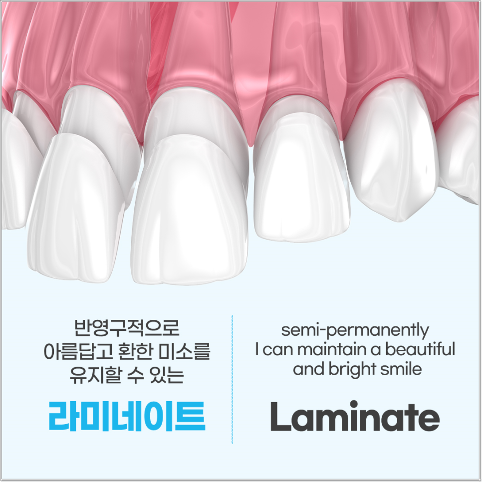 명동치과 치아 라미네이트의 모든 것: 앞니부터 어금니까지 관련 이미지 4