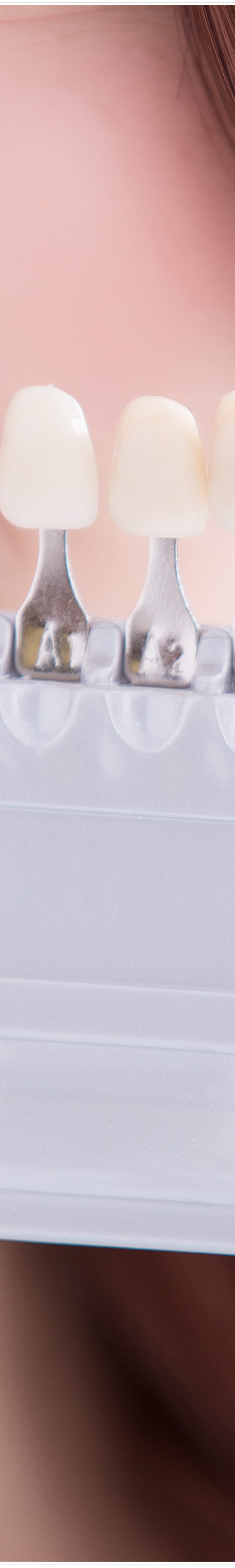 명동치과 라미네이트로 환하게 스마일~ 관련 이미지 13