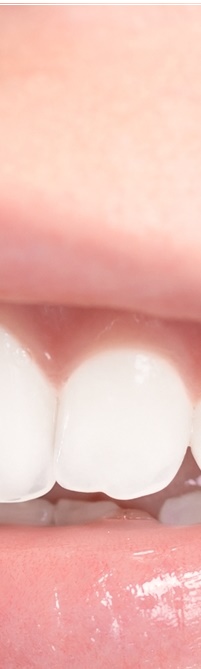 종로치과 라미네이트 주변 치아를 확인하여 자연스럽게 관련 이미지 13