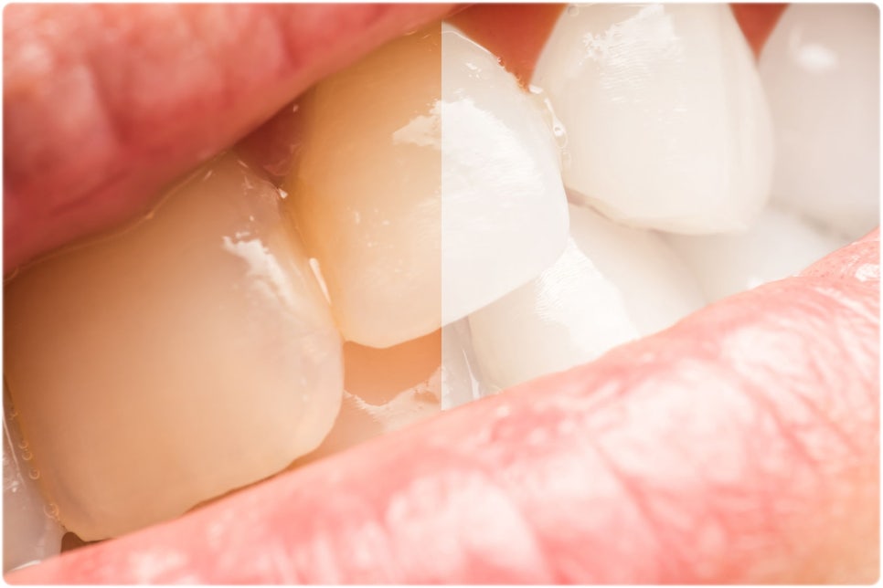 음주가 치아에 미치는 영향에는 어떤 것이 있을까요? 관련 이미지 3