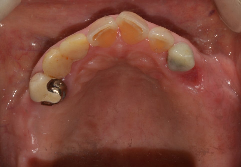 종로3가치과 틀니 사용 중인데 불편해서 임플란트 하고 싶어요 관련 이미지 3