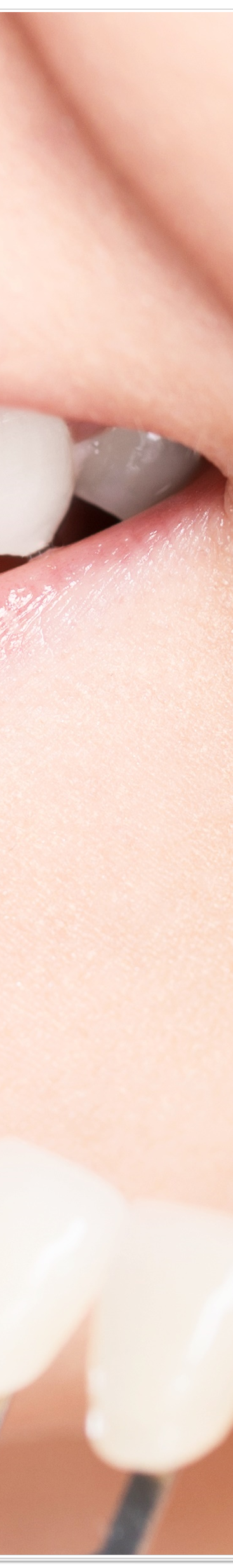 종로치과에서 알려드리는 치아미백과 라미네이트의 모든 것 관련 이미지 38