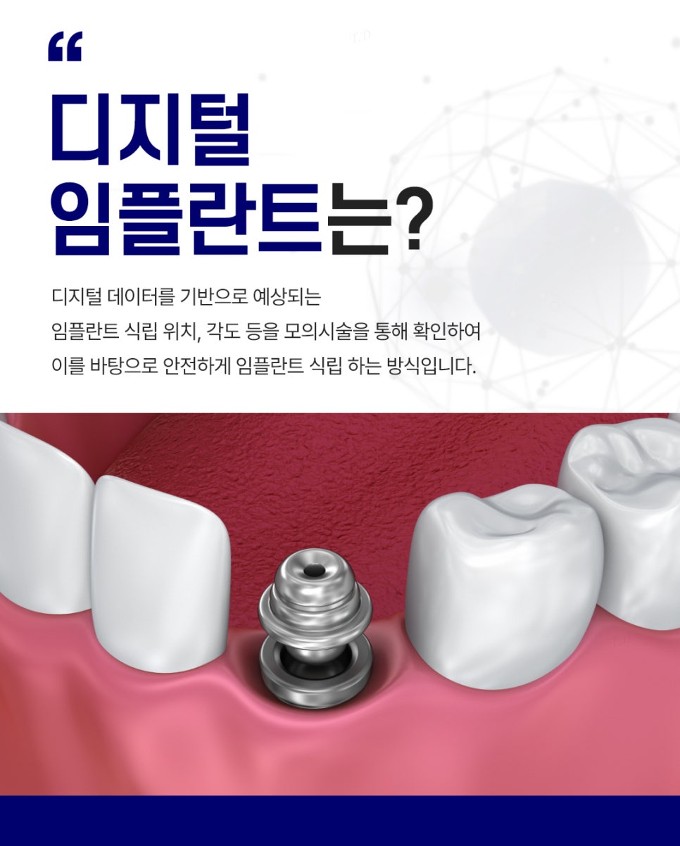 종각역치과 임플란트 치료, 이것만은 알고 계세요! 관련 이미지 4