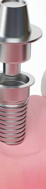 종로치과추천 나이별 &middot; 상황별 임플란트 치료 방법 관련 이미지 26