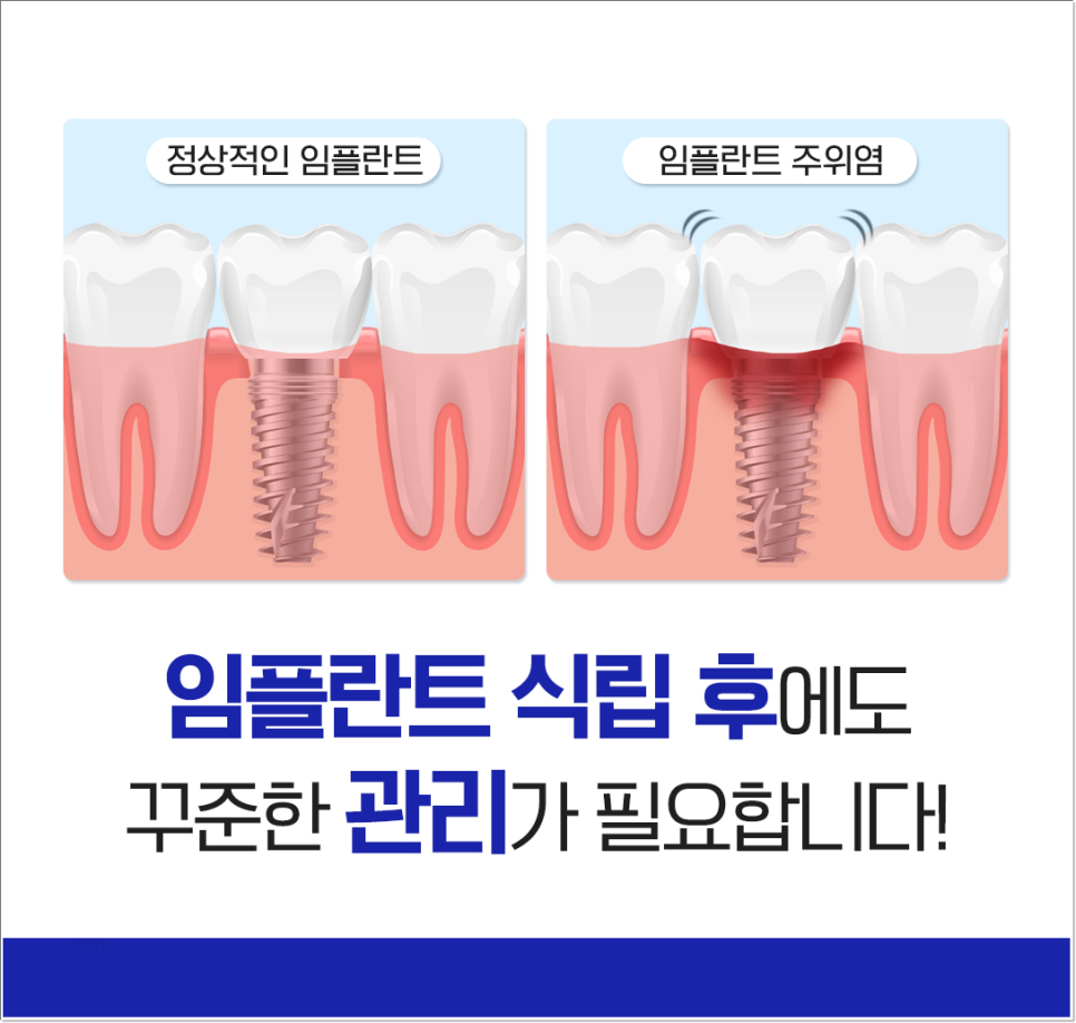광화문역치과 치아 상실에 임플란트가 필요한 이유 관련 이미지 6