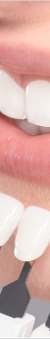 명동라미네이트, 단시간에 환한 미소를 가지고 싶다면? 관련 이미지 21