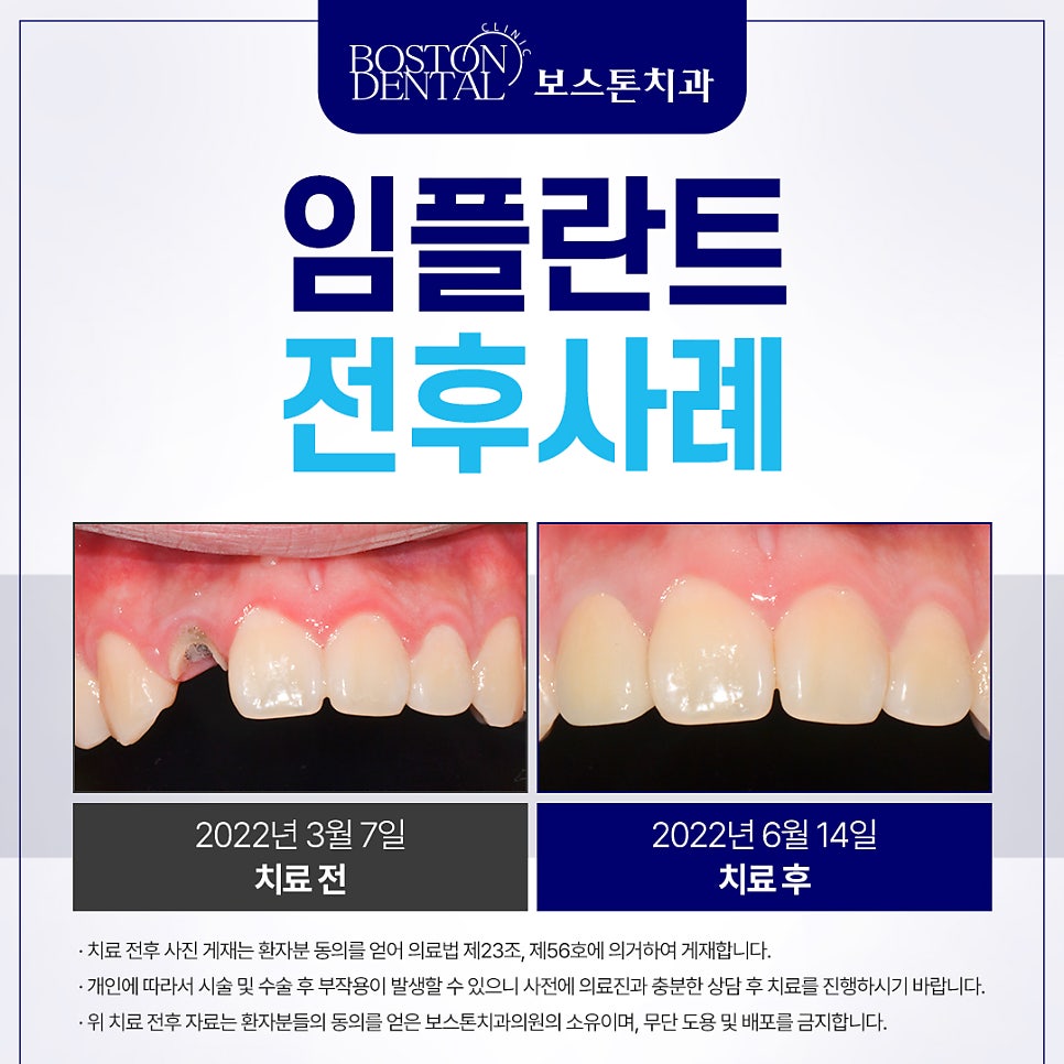 을지로치과 예전에 신경치료한 치아가 음식먹다가 부러졌어요. 관련 이미지 1