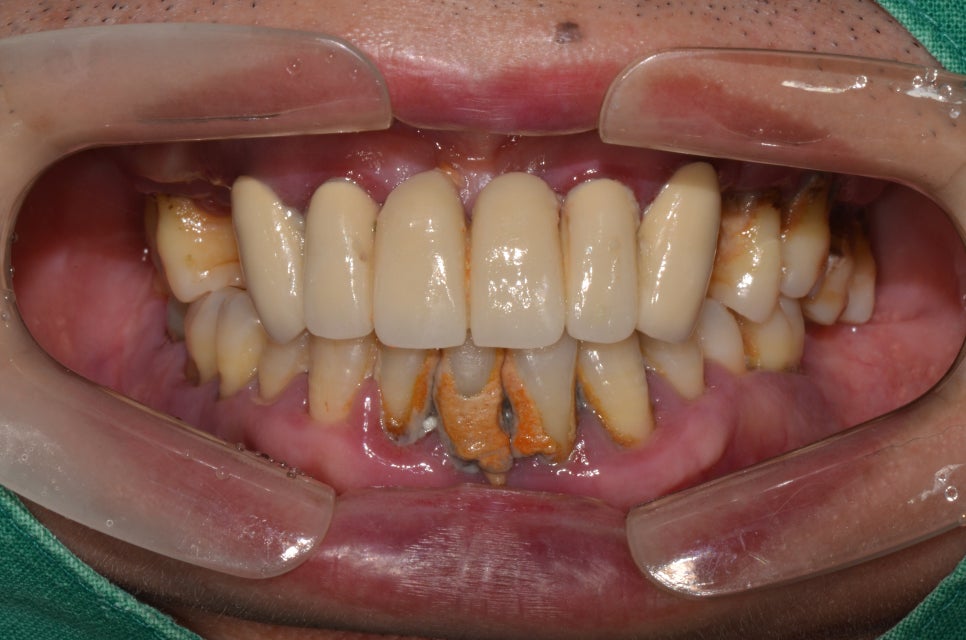 명동치과 잇몸이 안좋고 이가 계속 빠져서 밥먹기가 힘들어요. 관련 이미지 3