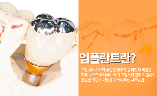 광화문임플란트 정확하게! 관련 이미지 2