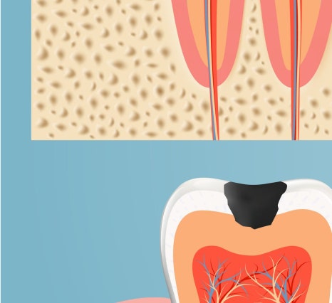 종로치과 충치가 생겼을 때 어떻게 치료 받아야 하나요? 관련 이미지 13