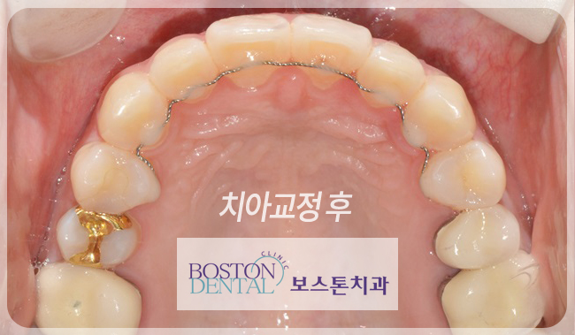 종로치아교정 안심하고 시작! 관련 이미지 4