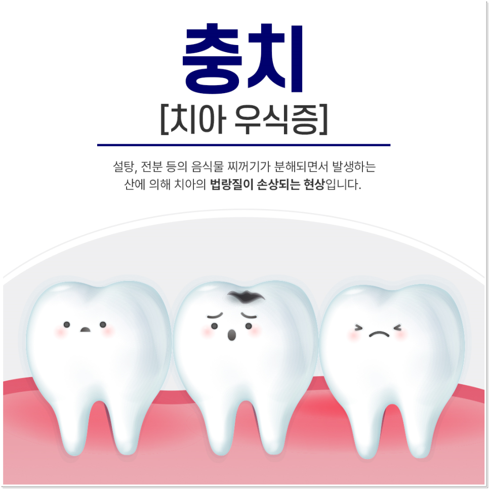 종로치과 충치치료는 조기 발견이 중요 관련 이미지 1