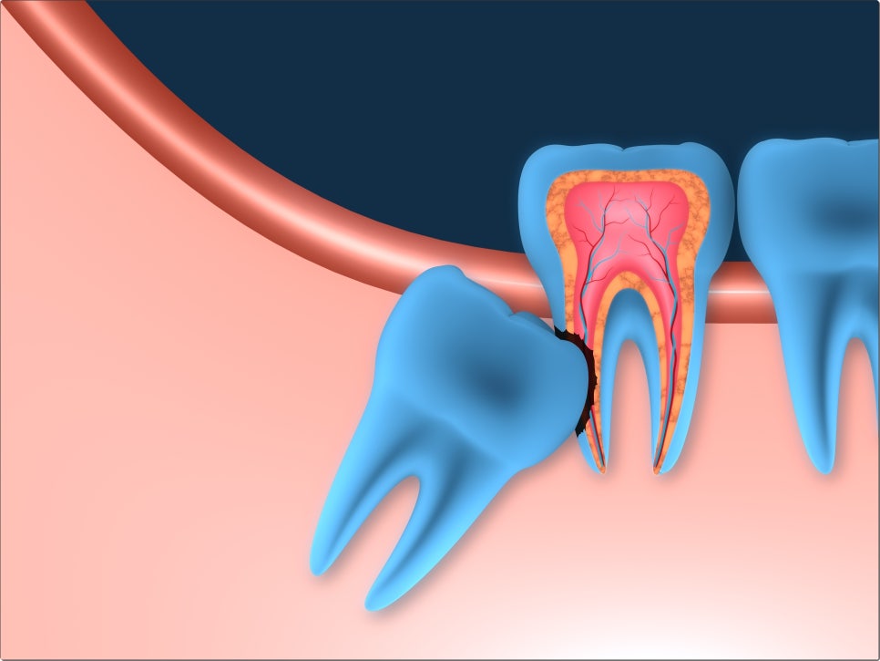 사랑니는 꼭 빼야 하는 치아일까요? 관련 이미지 2
