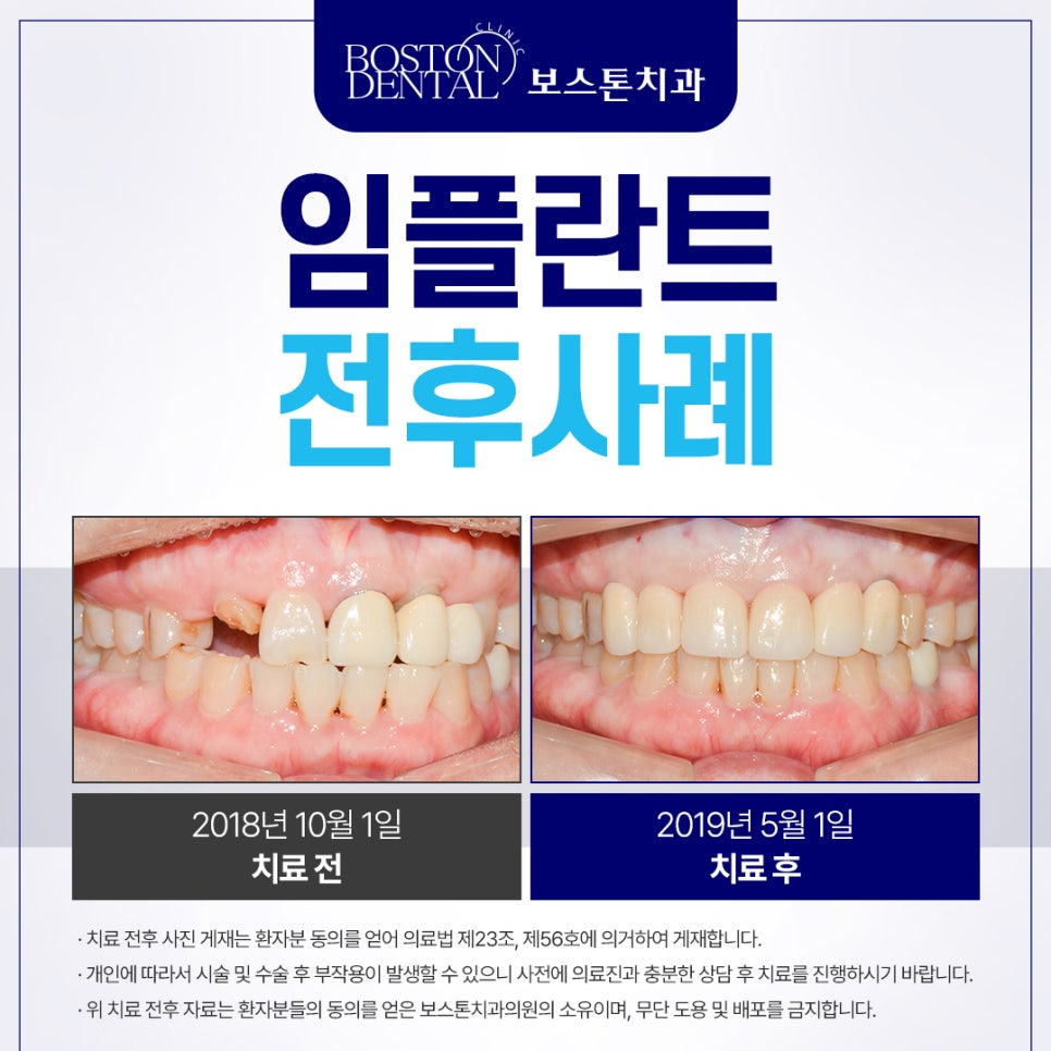 종로임플란트 아래 치아가 계속 위에 치아랑 닿는 거 같더니 위에 앞니가 깨졌어요 관련 이미지 2