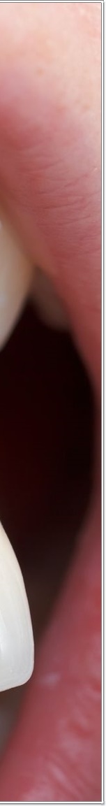 명동치과 치아 라미네이트의 모든 것: 앞니부터 어금니까지 관련 이미지 16