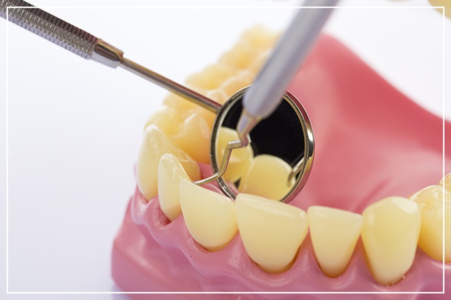 치아미백에 관한 모든 것! 관련 이미지 4