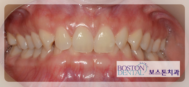 종각역치아교정 확실한 효과~! 관련 이미지 5