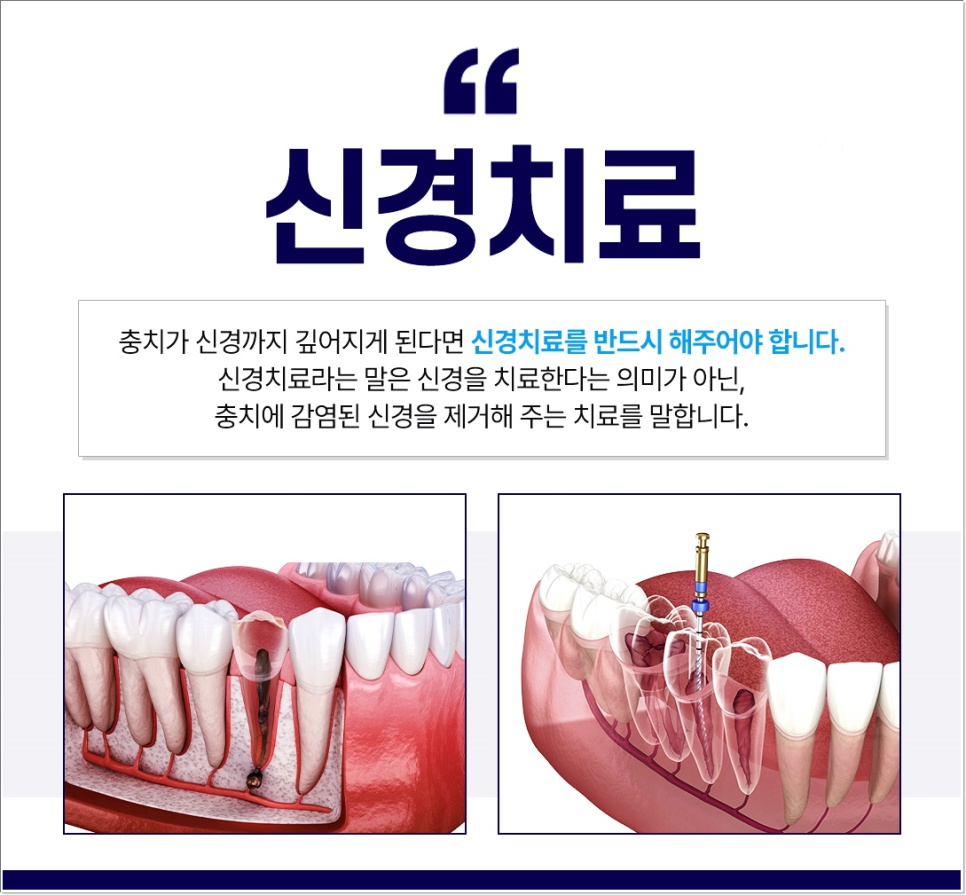 외국인치과 필수 가이드: 한국에서 알아야 할 5가지 핵심 치료 관련 이미지 3