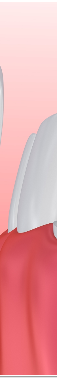 광화문역치과 치아미백과 라미네이트 나에게 필요한 건? 관련 이미지 8