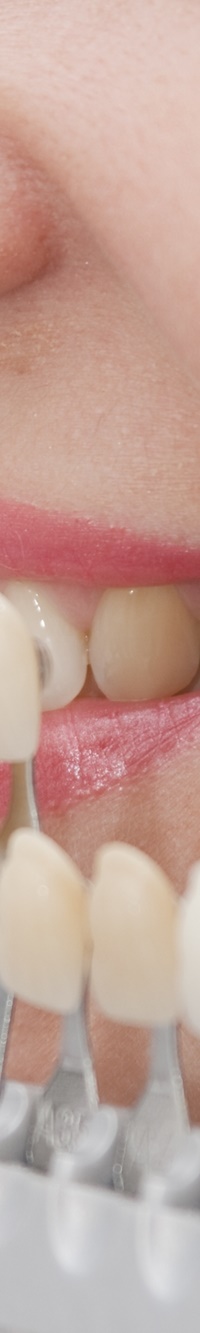 종로치과 자연스러운 라미네이트 색, 얼마나 하얘야 예쁠까? 관련 이미지 12