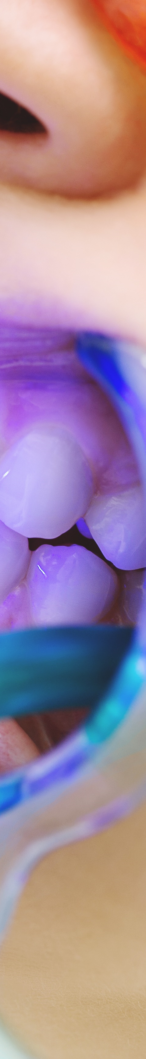 광화문역치과 치아미백과 라미네이트의 차이는? 관련 이미지 20