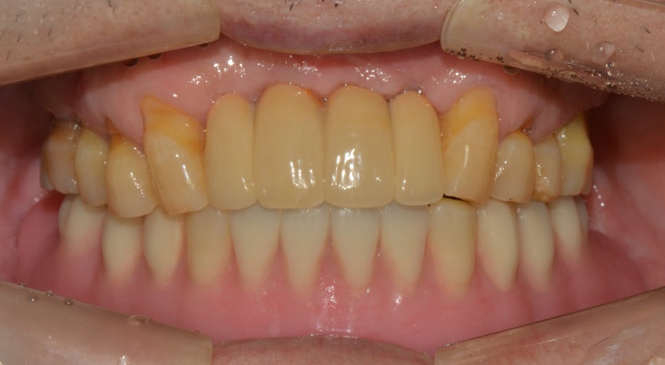 종로치과추천 이가 흔들려서 씹는게 불편해요 관련 이미지 6