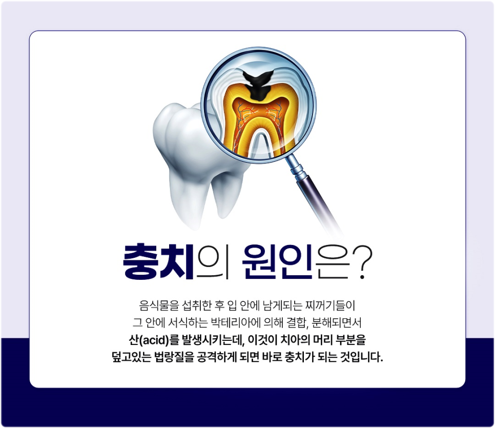 광화문역치과 신경치료 과정이 궁금해요 관련 이미지 2