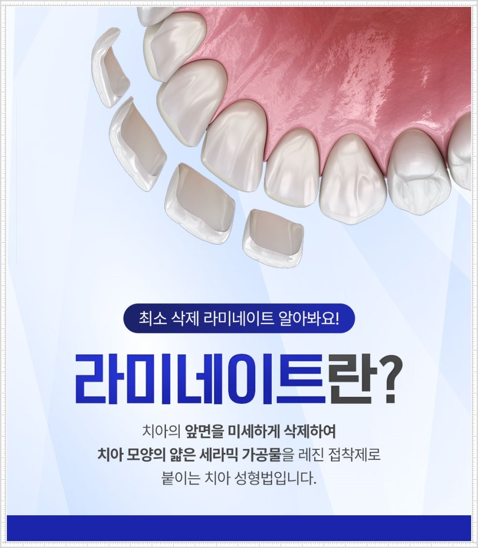 을지로입구치과 라미네이트 치료, 어디까지 알고 있나요? 관련 이미지 8