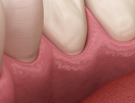 종각치과 너무 많은 치과 치료가 헷갈린다면? 관련 이미지 26