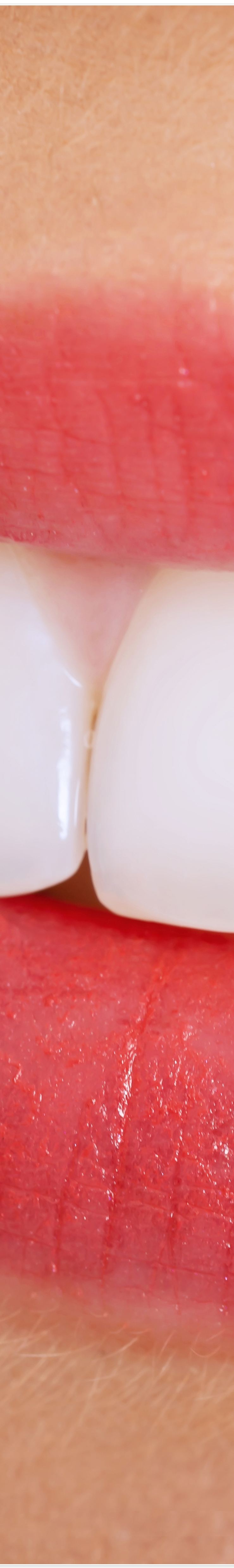 종로3가치과에서 알려드리는 무삭제 라미네이트 완벽 가이드 관련 이미지 13