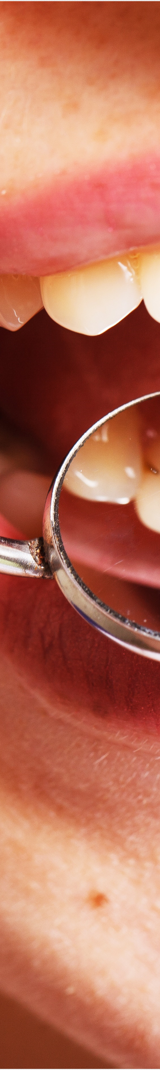 을지로입구역치과에서 알려드리는 치아미백과 라미네이트의 모든 것 관련 이미지 13