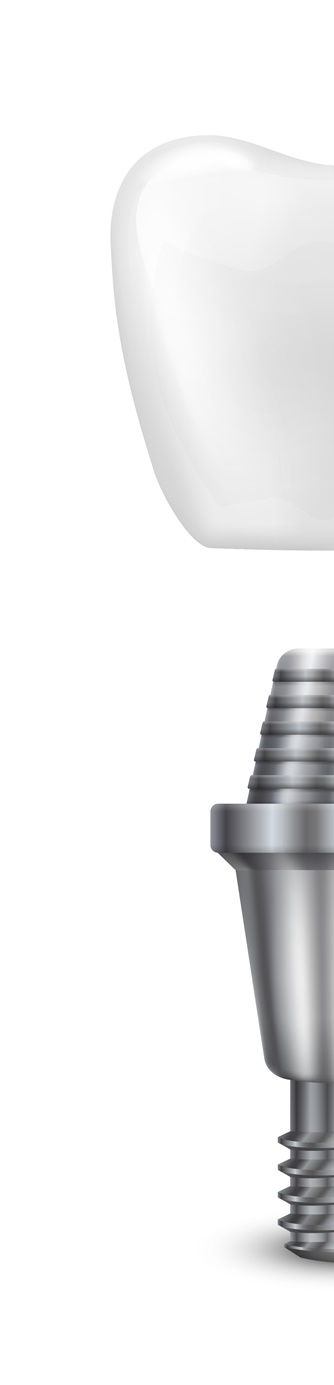 종로치과 임플란트 재식립이 필요하다면? 관련 이미지 9